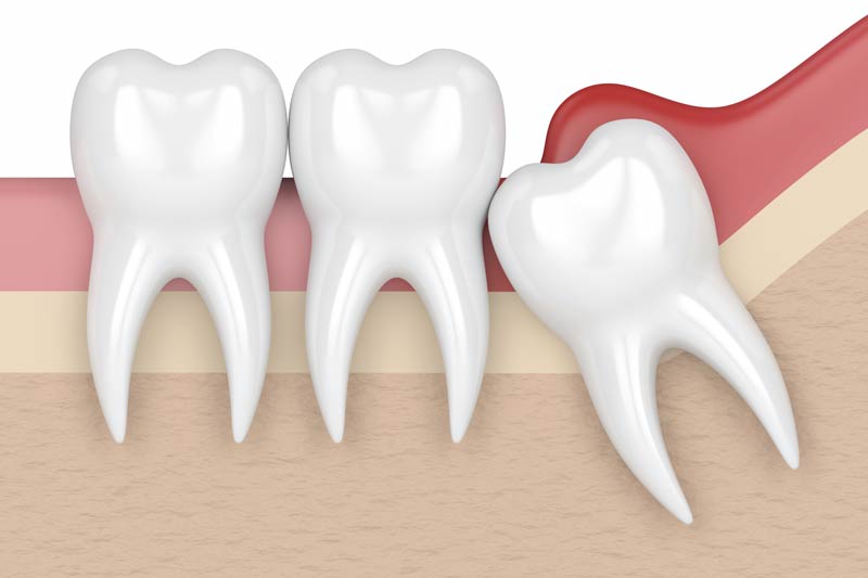 Wisdom Tooth Removal in Elk Grove